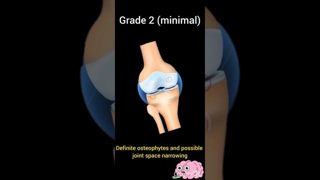 #Osteoarthritis #Knee #Classification #Grades смотреть онлайн