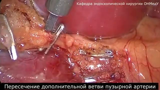 Холецистэктомия смотреть онлайн