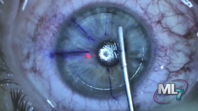 EXIMEQ ML7 100 Micron LASIK Video смотреть онлайн