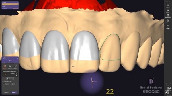 Exocad Gingival splint I Tooth Modeling 31