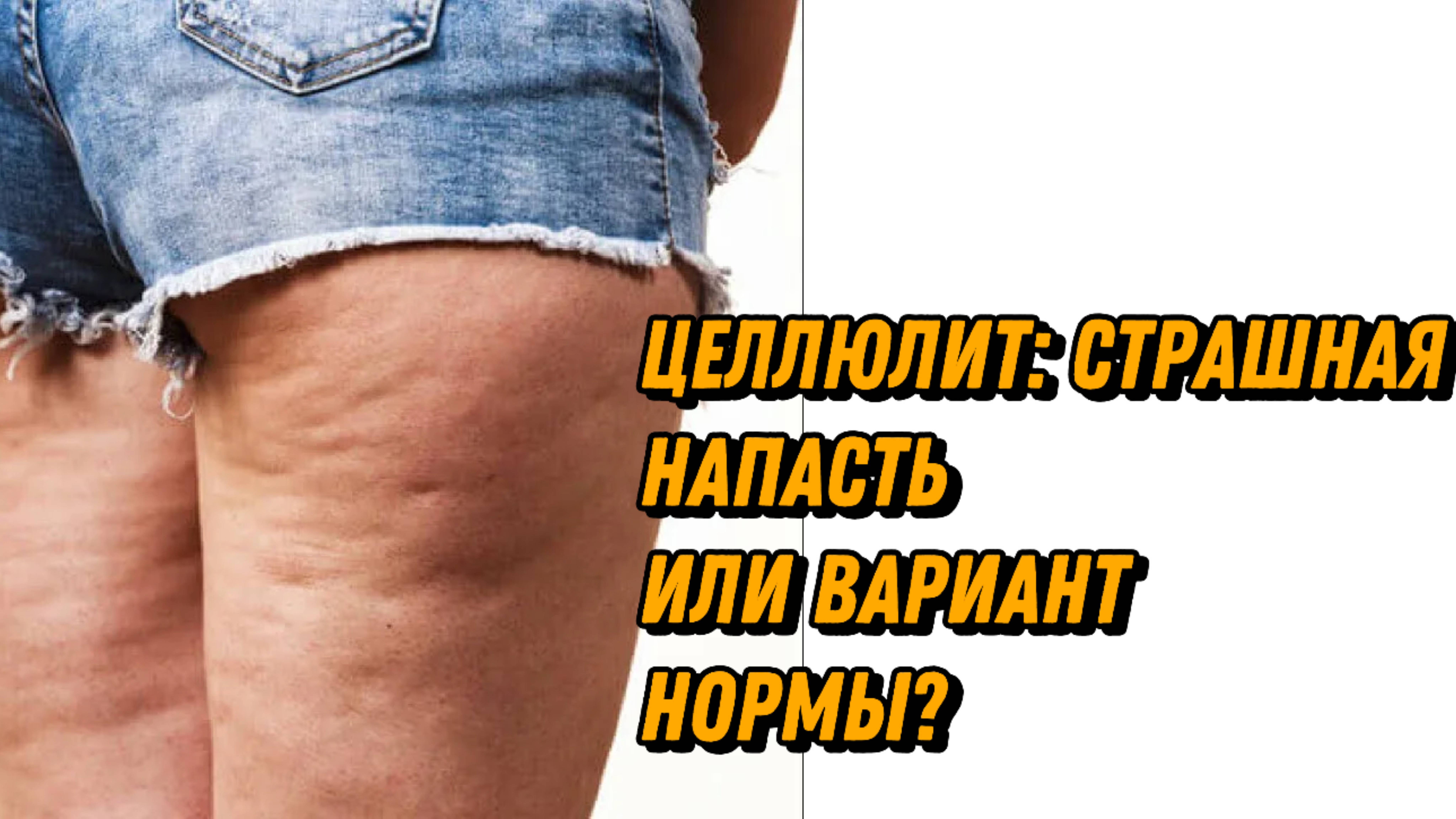 ⚠️ ЦЕЛЛЮЛИТ: СТРАШНАЯ НАПАСТЬ ИЛИ ВАРИАНТ НОРМЫ? смотреть онлайн