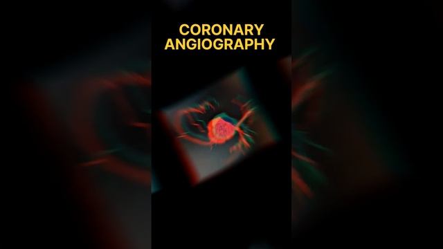 Ct coronary angiography #ctscan #radiology #coronary #angiogram #heart @hemantkushwah3453 смотреть онлайн