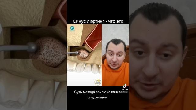 Синус лифтинг-что это? #стоматолог #зубнойврач #дантист #зубы #dişhekimi #diş #стоматология #имплан смотреть онлайн