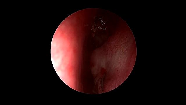 Επίμονη ρινική συμφόρηση - Υπερτροφία ρινικών κογχών μεγάλου βαθμού - Ενδοσκοπική Κογχοπλαστική смотреть онлайн