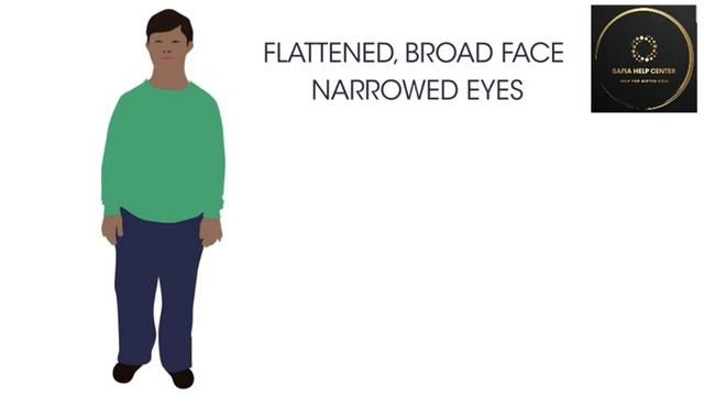 Which parents carries Down syndrome?What is Down syndrome?  Trisomy 21,Down syndrome. #downsyndrome смотреть онлайн