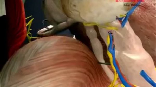 Операция простатэктомия