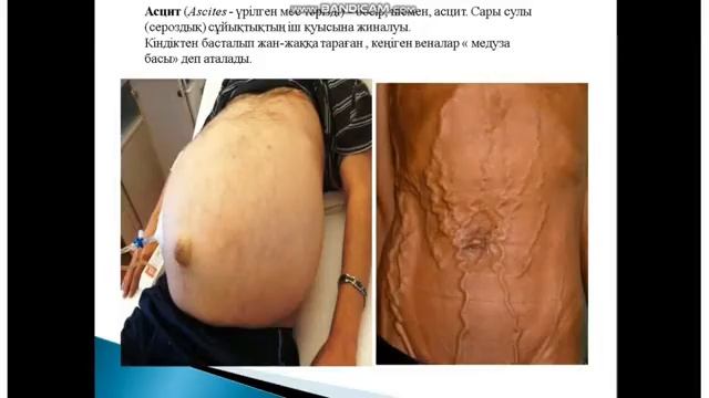 Бауыр, өт жолдарының ауруларымен науқастарды клиникалық тексеру әдістері смотреть онлайн