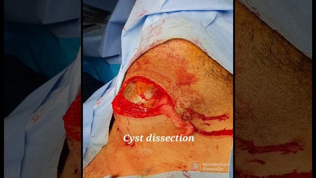 Thyroglossal Duct Cyst 52 years old male смотреть онлайн
