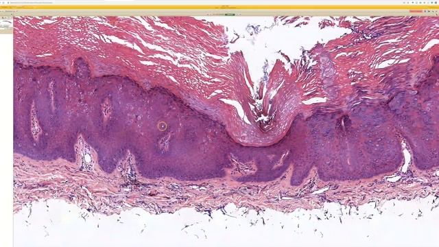 Epidermodysplasia Verruciformis (EDV): 5-Minute Pathology Pearls смотреть онлайн