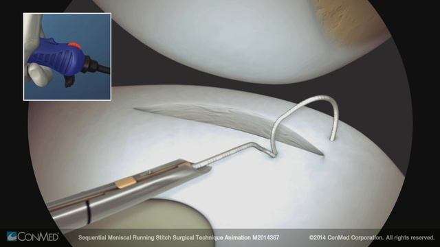 Sequential Meniscal Running Stitch Using Sequent® - CONMED Animation смотреть онлайн