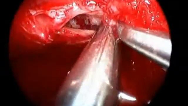 Pituitary adenoma, endonasal expanded approach, carotid dissection part 2 смотреть онлайн
