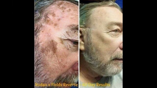 Age Spot Removal Before and After Photos смотреть онлайн