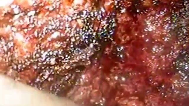 Laparoscopic Segment VI Hepatectomy смотреть онлайн