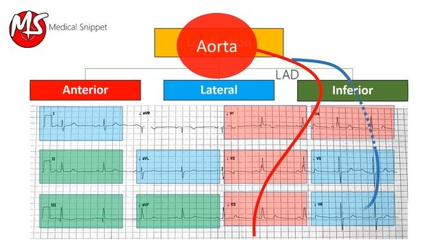 ECG localisation of the occluded coronary artery (Myocardial Infarction) смотреть онлайн