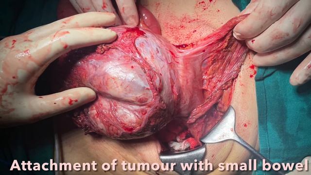 Video presentation on GIST(gastrointestinal stromal tumour) смотреть онлайн