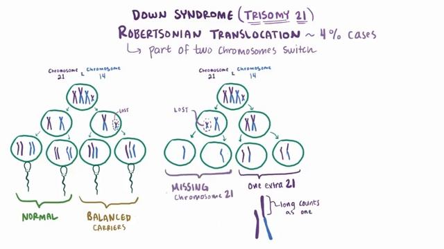 Down Syndrome (trisomy 21) - Causes, Symptoms, Diagnosis, & Pathology