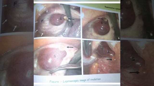 *FIGURE LEPROSCOPIC IMAGE OF OVULATION.*SLIDESHOW BY NURTAZUL KHAN. смотреть онлайн