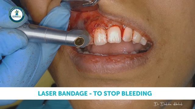 Painless Laser Surgery Of Oral Epulis