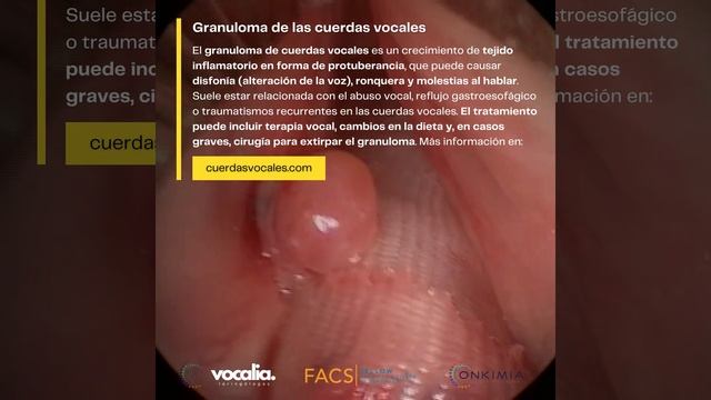 El Granuloma de las Cuerdas Vocales - Vocal fold granuloma смотреть онлайн