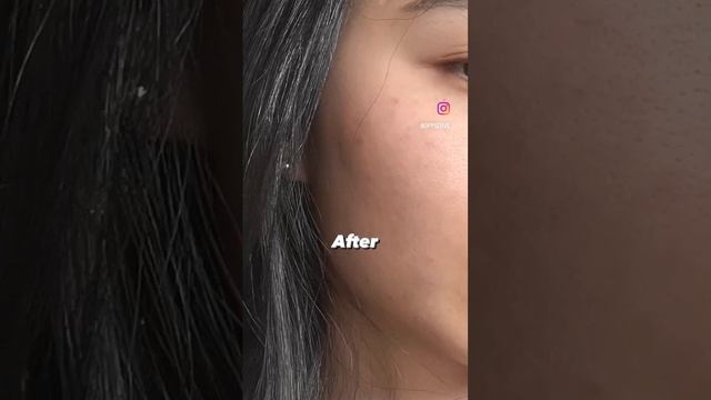 5 tips to heal your skin #acne #SkinCare #clearskin #skincaretips #tips #skincareroutine смотреть онлайн