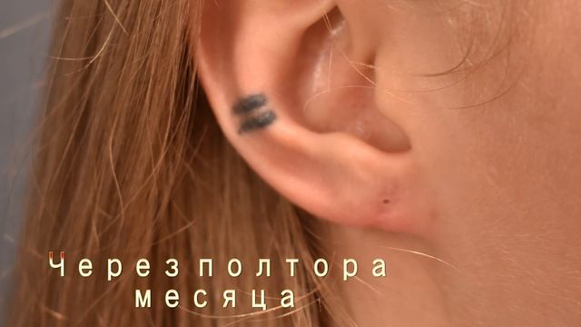 Зашивание тоннелей и реконструкция мочки смотреть онлайн