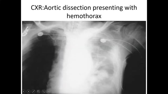 ACUTE AORTIC DISSECTION,AHMED SOBHY смотреть онлайн