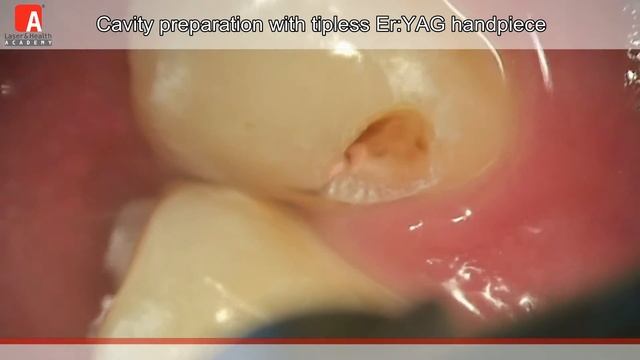 CAVITY PREPARATION Fotona Lightwalker Er:YAG laser смотреть онлайн