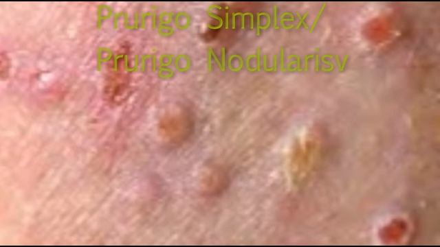 Prurigo Simplex/Prurigo Nodularis смотреть онлайн