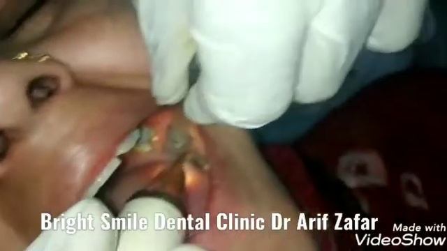 Piezosurgery is a relatively new technique for osteotomy and osteoplasty that utilizes смотреть онлайн