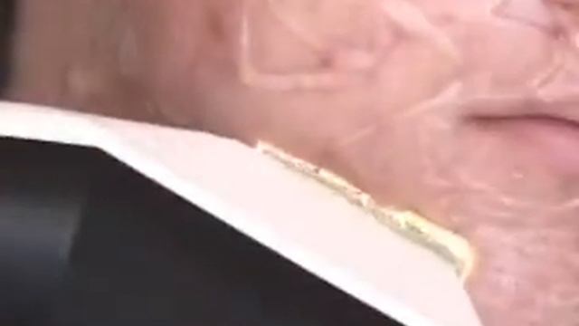 Ellipse tratamiento de acné facial.wmv смотреть онлайн