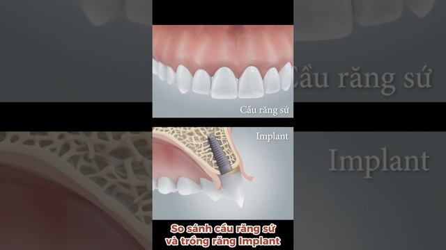 So sánh làm cầu răng sứ vs trồng răng Implant смотреть онлайн