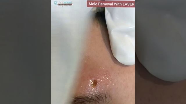Painless Mole Removal Surgery . смотреть онлайн