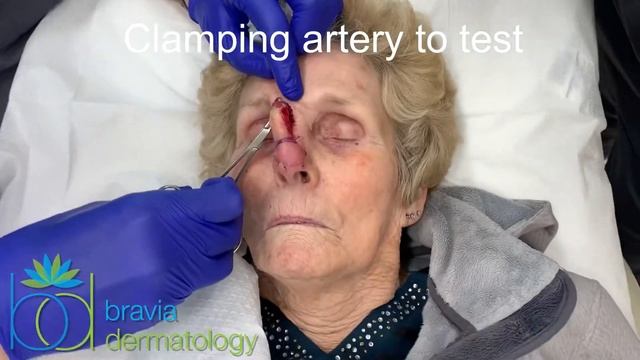 Forehead flap takedown at Bravia Derm in Toledo смотреть онлайн