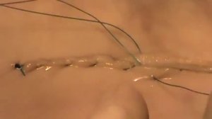 Кишечный шов Шмидена _intestinal sutures  Schmieden