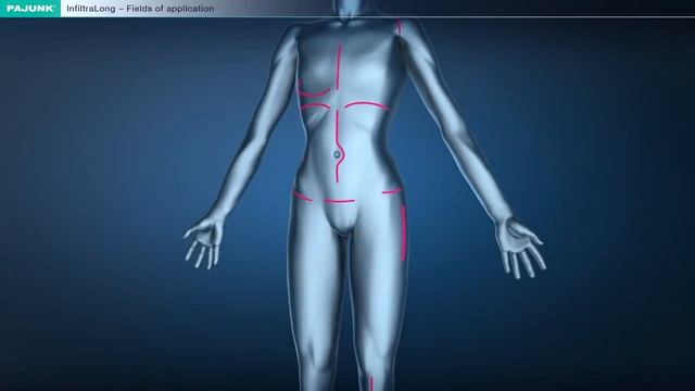 Pajunk InfiltraLong Catheter смотреть онлайн