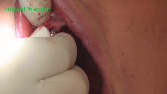 Dr. Gustavo and Dr. Avital Tooth to Mucosa with Closed Sinus lift Closed смотреть онлайн