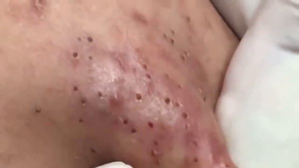 blackheads whiteheads removal acne treatment