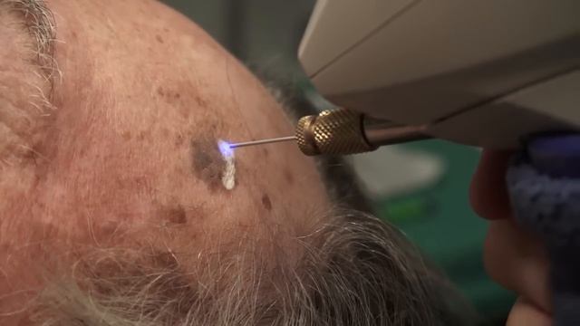Watch & Learn: Cryosurgery смотреть онлайн