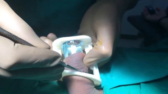 Adult Circumcision Aliskamp