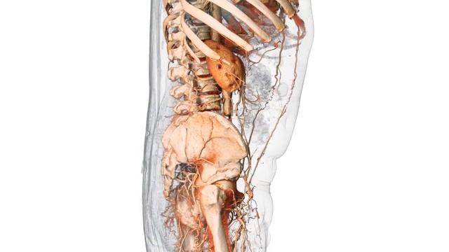 3D Aortic Occlusion смотреть онлайн