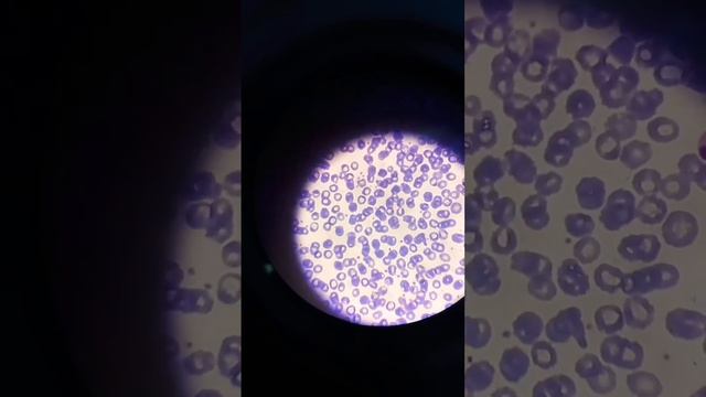 Red blood cells morphology under microscope. смотреть онлайн
