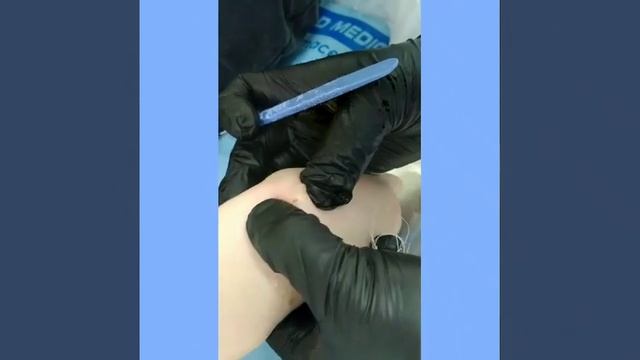 Вскрытие гигромы смотреть онлайн