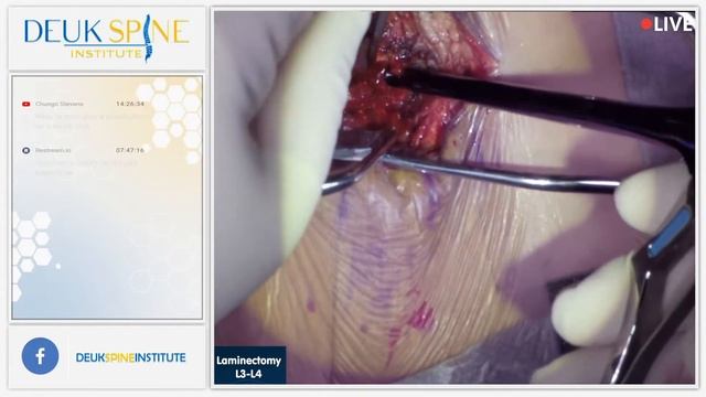 Watch Live Spine Surgery! Laminectomy L3-L4 смотреть онлайн