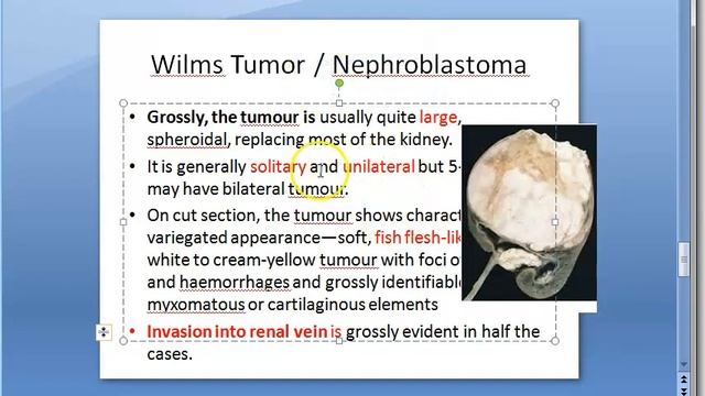 Pathology 700 a Wilms Tumor Kidney Nephroblastoma embryonal WAGR syndrome microscopy cancer child смотреть онлайн