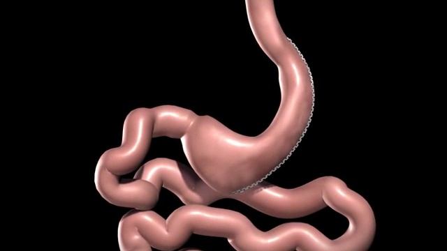 Продольная (рукавная, рестриктивная, sleeve- resection) резекция желудка смотреть онлайн