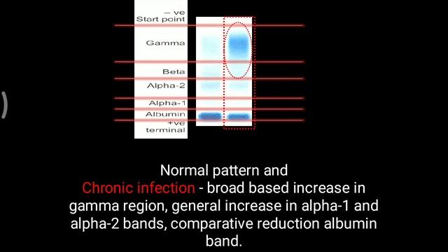 Serum electrophoresis patterns смотреть онлайн