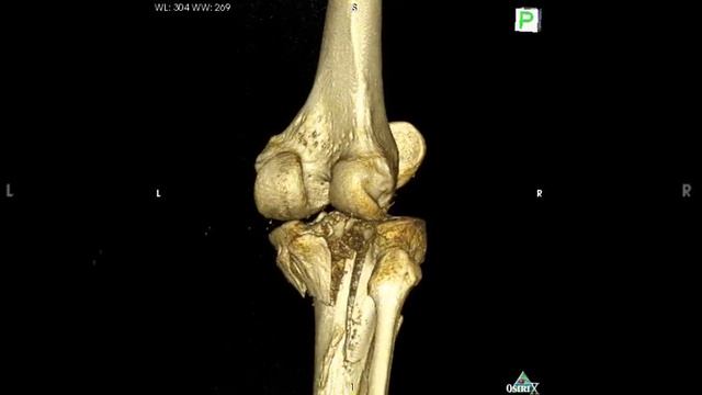 X-Ray Computed Tomography of Knee смотреть онлайн
