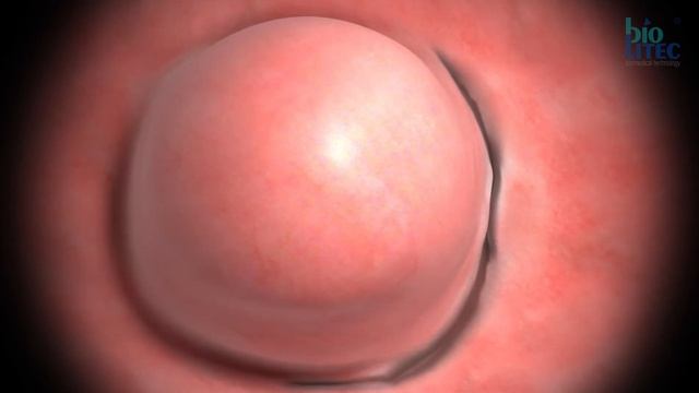HOLA – Animation myoma enucleation by biolitec® смотреть онлайн