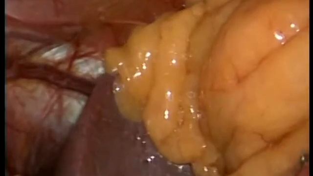 Лапароскопическая фундопликация по Ниссену смотреть онлайн