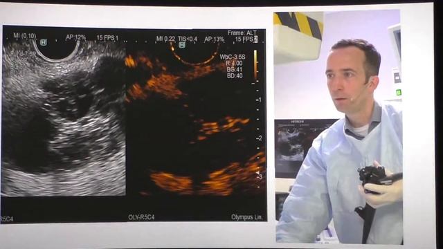 45 EndoclubNord2018 Th von Hahn EUS pancreatic cyst смотреть онлайн
